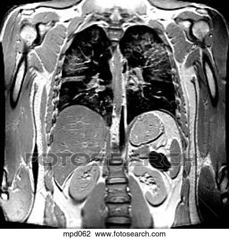 Upper Torso - Coronal View Large Illustration Drawing - Upper Torso - Coronal. Fotosearch