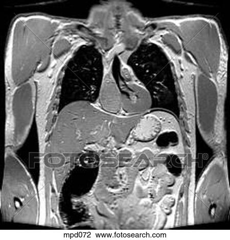 Upper Torso - Coronal View Large Illustration Drawing - Upper Torso - Coronal. Fotosearch