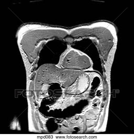 Upper Torso - Coronal View Large Illustration Drawing - Upper Torso - Coronal. Fotosearch