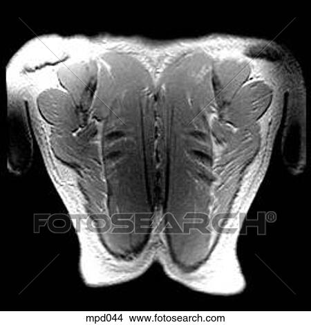 Upper Torso - Coronal View Large Illustration Stock Illustration - Upper Torso - Coronal. Fotosearch