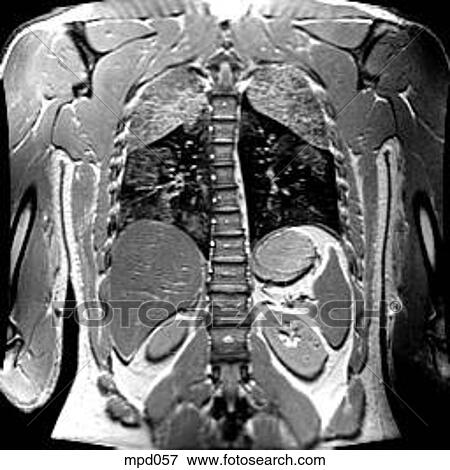 Upper Torso - Coronal View Large Illustration Stock Illustration - Upper Torso - Coronal. Fotosearch