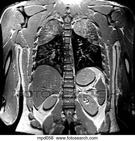 Upper Torso - Coronal View Large Illustration Stock Illustration - Upper Torso - Coronal. Fotosearch