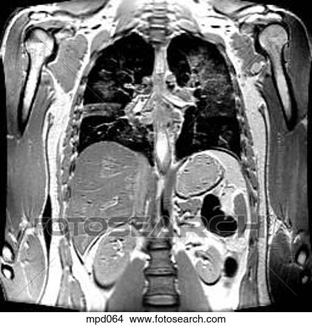 Upper Torso - Coronal View Large Illustration Stock Illustration - Upper Torso - Coronal. Fotosearch