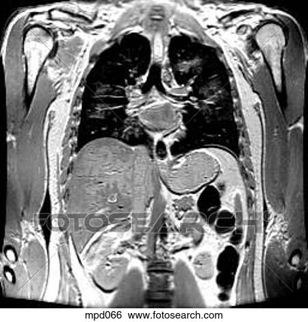 Upper Torso - Coronal View Large Illustration Stock Illustration - Upper Torso - Coronal. Fotosearch