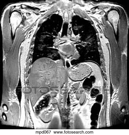 Upper Torso - Coronal View Large Illustration Stock Illustration - Upper Torso - Coronal. Fotosearch