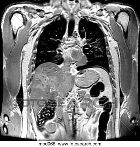 Upper Torso - Coronal View Large Illustration Stock Illustration - Upper Torso - Coronal. Fotosearch