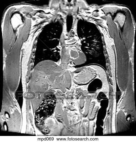 Upper Torso - Coronal View Large Illustration Stock Illustration - Upper Torso - Coronal. Fotosearch
