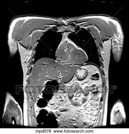 Upper Torso - Coronal View Large Illustration Stock Illustration - Upper Torso - Coronal. Fotosearch