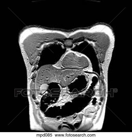 Upper Torso - Coronal View Large Illustration Stock Illustration - Upper Torso - Coronal. Fotosearch