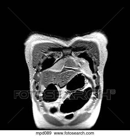 Stock Illustration - Upper Torso - Coronal. Fotosearch