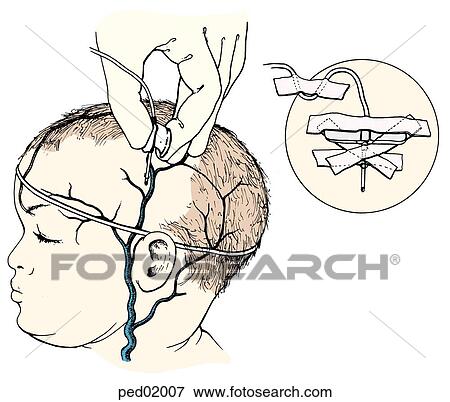 イラスト の 技術 使われた 中に 頭皮 静脈 Catheterization 蝶 カテーテル ある について へ ありなさい 差し込まれた に 頭皮 静脈 の Infant 挿入 ショー カテーテル テープに取られた に Place イラスト Ped007 Fotosearch