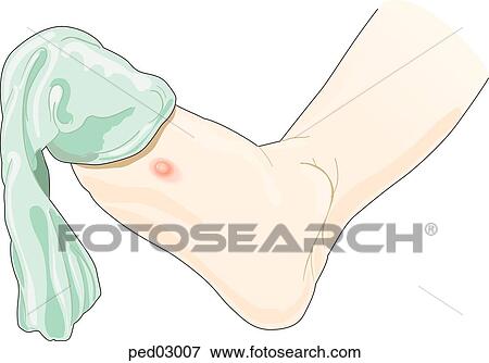 イラスト ショー 底 の 子供 Foot ソックス ある 部分的に 取り去られた 残物 上に Toes 水ぶくれ ある 示されている 上に 球技 の Foot イラスト Ped Fotosearch