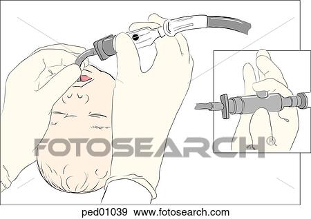 イラスト デモをする 適切 使用 の Meconium 吸引器 中に Suctioning Meconium から 気管 の Intubated Newborn 挿入図 ショー 正しい 位置 の 指 ために 吸引器 Operation イラスト Ped Fotosearch