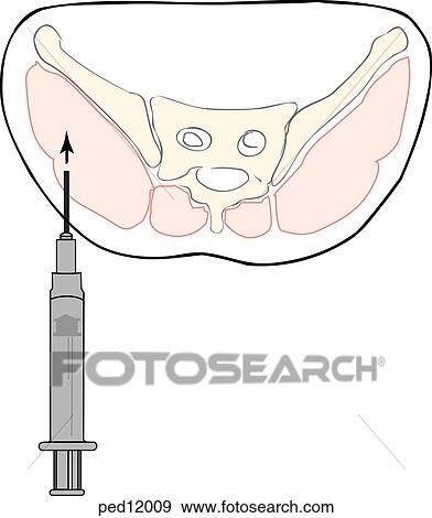 技術 ために 筋肉内 注入 中に 子供 Dorsogluteal Site イラスト ショー クロスセクション の 骨盤の範囲 において 注入 サイト 指摘 位置 の 切望された 筋肉 Maximus 媒体 Minimus Gluteal Mm イラスト Ped109 Fotosearch