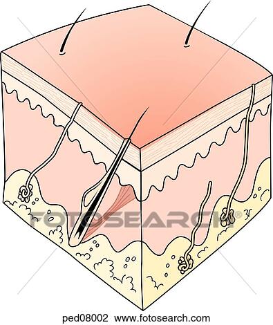A cross-section of skin showing effects of a first-degree burn on the skin layers. View Large Illustration Drawing - A cross-section of skin showing effects of a first-degree burn on the skin layers.. Fotosearch