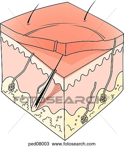 A cross-section of skin showing effects of a second-degree burn on the skin layers; note blistering of epidermis. View Large Illustration Drawing - A cross-section of skin showing effects of a second-degree burn on the skin layers; note blistering of epidermis.. Fotosearch