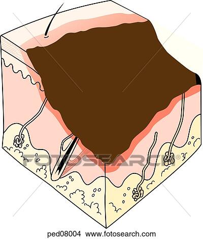 Stock Illustration - A cross-section of skin showing effects of a third-degree burn on the skin layers; note charring and loss of tissue down into the subcutaneous layer.. Fotosearch