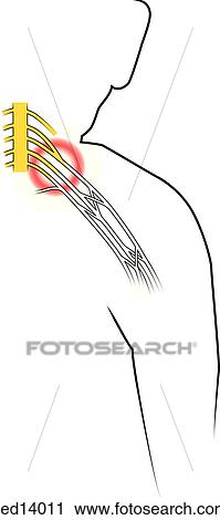 Anatomy of brachial plexus region showing damage to the cervical nerve roots resulting in Erb's palsy. View Large Illustration Clip Art - Anatomy of brachial plexus region showing damage to the cervical nerve roots resulting in Erb's palsy.. Fotosearch