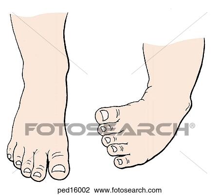 Drawing - Anterior view of a child's two feet, the left of which is clubbed; ankle is plantar flexed, foot is inverted, anterior half of foot is directed toward midline.. Fotosearch