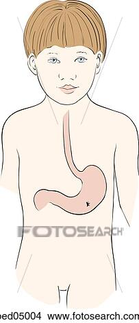 Stock Illustration - Anterior view of child with location of stomach and site of stoma indicated.. Fotosearch