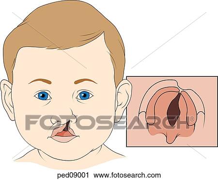 Clip Art - Anterior view of child's face showing a cleft of the upper lip that extends upward to include the left nostril; insert shows inferior view of the palate with cleft extending along the midline.. Fotosearch