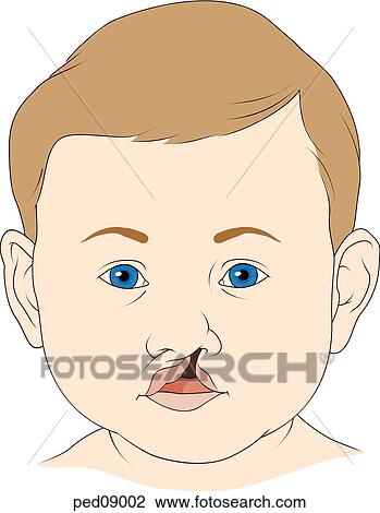 Anterior view of child's face showing a cleft of the upper lip that extends upward to include the left nostril. View Large Illustration Drawing - Anterior view of child's face showing a cleft of the upper lip that extends upward to include the left nostril.. Fotosearch
