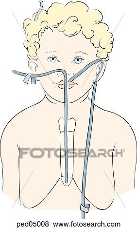 Anterior view of head and chest of a child with nasogastric tube placed against external landmarks, which are used to determine desired length of tube; two different methods are shown using different sets of landmarks. View Large Illustration Stock Illustration - Anterior view of head and chest of a child with nasogastric tube placed against external landmarks, which are used to determine desired length of tube; two different methods are shown using different sets of landmarks.. Fotosearch