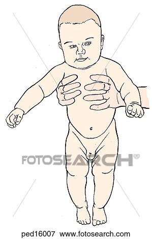 Anterior view of infant supported in standing position by adult; note left thigh has more thigh folds than right. View Large Illustration Stock Illustration - Anterior view of infant supported in standing position by adult; note left thigh has more thigh folds than right.. Fotosearch