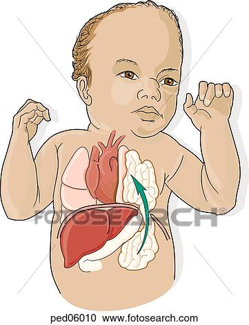 Clipart - Anterior view of infant with a diaphragmatic hernia; note bowel having passed through diaphragm into thoracic cavity.. Fotosearch