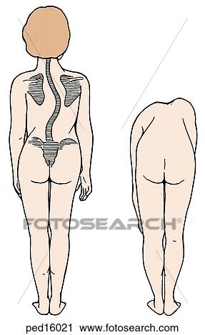 Clip Art - Anterior view of young female with scoliosis; (left] patient is standing upright with scapula, spinal column and iliac crests visible; note curvature of spine and asymmetry of paired bilateral structures; (right) patient is bending forward from waist, a . Fotosearch