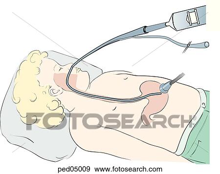 Stock Illustration - Anterolateral view of head and chest of supine child with nasogastric tube in place; auscultation over epigastric region confirms proper placement.. Fotosearch