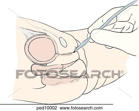 Bladder catheterization for girls; catheter is introduced into urethral meatus. View Large Illustration Drawing - Bladder catheterization for girls; catheter is introduced into urethral meatus.. Fotosearch