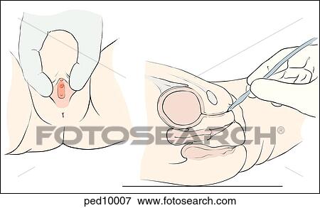 Stock Illustration - Bladder catheterization for girls; catheter is introduced into urethral meatus; insert: lateral traction of labia allows visualization of urethral meatus.. Fotosearch