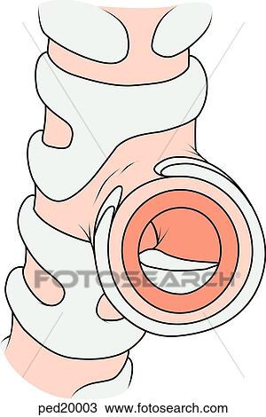 Blow up and cutaway of a bronchus; note swelling and inflammation of mucous membrane and fluid within the bronchus, symptoms of bronchitis. View Large Illustration Drawing - Blow up and cutaway of a bronchus; note swelling and inflammation of mucous membrane and fluid within the bronchus, symptoms of bronchitis.. Fotosearch