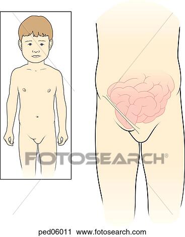 Bowel has passed under inguinal ligament resulting in an inguinal hernia. Insert shows external appearance. View Large Illustration Clip Art - Bowel has passed under inguinal ligament resulting in an inguinal hernia. Insert shows external appearance.. Fotosearch