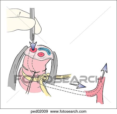 Stock Illustration - Catheter is shown being inserted into umbilical arterial lumen and passed into internal iliac artery through umbilical artery.. Fotosearch
