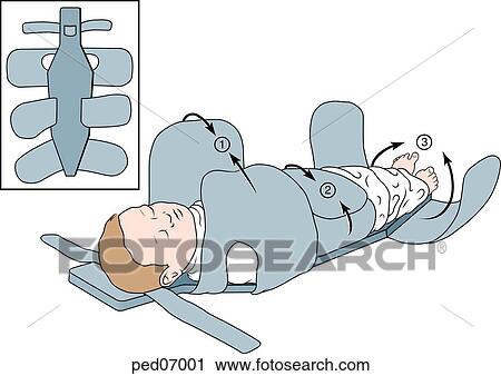 Clip Art - Child is restrained in a papoose board, initially across the abdomen, followed by trunk and arms, then the legs; insert shows papoose board with restraints open, not in use.. Fotosearch