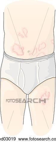 Stock Illustration -  child suffering from ringworm (tinea corporis); note the typical small ring-like structures on the abdomen and thigh.. Fotosearch