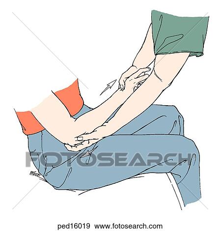 Child undergoing closed-joint reduction of the radial head; technique shown: hand of injured extremity grasped in handshake position; other hand placed behind elbow with thumb on radial head; longitudinal traction applied; forearm supinated while keep View Large Illustration Stock Illustration - Child undergoing closed-joint reduction of the radial head; technique shown: hand of injured extremity grasped in handshake position; other hand placed behind elbow with thumb on radial head; longitudinal traction applied; forearm supinated while keep. Fotosearch