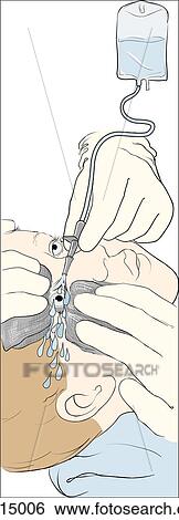 Stock Illustration - Child undergoing irrigation of conjunctiva; assistant retracts eyelids with gauze pads; eye is irrigated using standard intravenous setup, with intravenous tubing held just above eyeball to allow free flow of saline.. Fotosearch