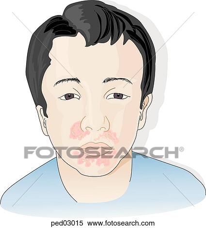 Stock Illustration -  child with impetigo in the areas where it typically occurs near the mouth and nose.. Fotosearch