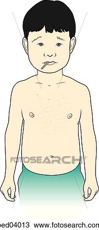 Child with typical small red dots on chest associated with petechiae; often associated with fever. View Large Illustration Drawing - Child with typical small red dots on chest associated with petechiae; often associated with fever.. Fotosearch