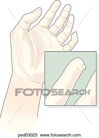 Stock Illustration - Child's hand with warts; insert shows close-up of a wart.. Fotosearch
