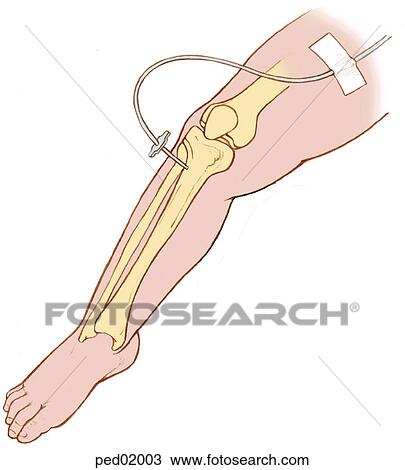 Drawing - Child's leg with bone structure visible to show interosseous catheter inserted in the tibia.. Fotosearch