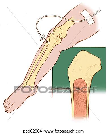 Child's leg with bone structure visible to show placement of interosseous catheter in the tibia; inset shows cross-section of tibial tuberosity with catheter needle in place within the bone. View Large Illustration Stock Illustration - Child's leg with bone structure visible to show placement of interosseous catheter in the tibia; inset shows cross-section of tibial tuberosity with catheter needle in place within the bone.. Fotosearch
