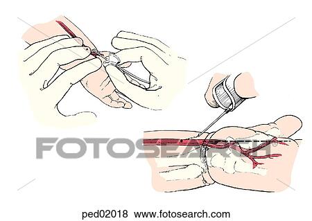 Child's wrist and hand with blood supply visible to show placement of butterfly needle in radial arterial puncture; (top) left adult hand locates vessel in child's wrist, right hand pinches "butterfly" and inserts needle; (bottom) close-up of butterfly n View Large Illustration Stock Illustration - Child's wrist and hand with blood supply visible to show placement of butterfly needle in radial arterial puncture; (top) left adult hand locates vessel in child's wrist, right hand pinches "butterfly" and inserts needle; (bottom) close-up of butterfly n. Fotosearch