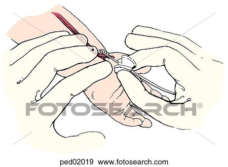 Child's wrist and hand with blood supply visible to show placement of butterfly needle in radial arterial puncture; left adult hand locates vessel in child's wrist, right adult hand pinches "butterfly" and inserts needle. View Large Illustration Stock Illustration - Child's wrist and hand with blood supply visible to show placement of butterfly needle in radial arterial puncture; left adult hand locates vessel in child's wrist, right adult hand pinches "butterfly" and inserts needle.. Fotosearch