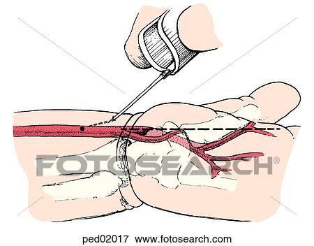 Download Close-up of butterfly needle being inserted into child's ...