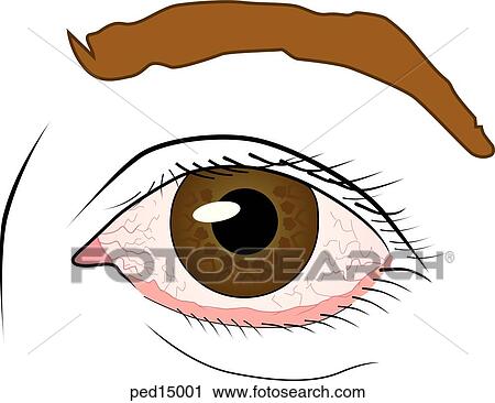Close-up of left eye with conjunctiva visibly inflamed. View Large Illustration Clip Art - Close-up of left eye with conjunctiva visibly inflamed.. Fotosearch