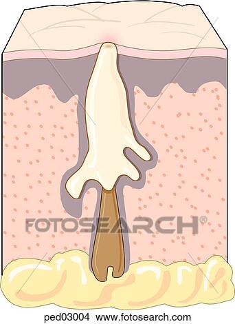 Cross-section of hair follicle and sebaceous gland of the skin showing the first stage in the development of acne; follicle becomes blocked, sebum begins to fill follicle cavity. View Large Illustration Stock Illustration - Cross-section of hair follicle and sebaceous gland of the skin showing the first stage in the development of acne; follicle becomes blocked, sebum begins to fill follicle cavity.. Fotosearch